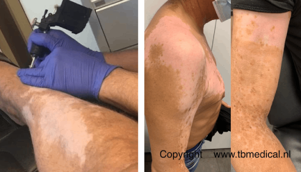 medische tatoeage litteken