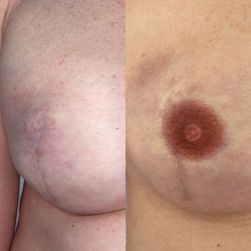 medische tatoeage tepel