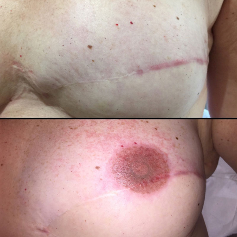 medische tattoo litteken